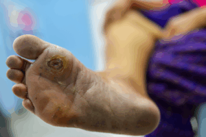 BQ-foto-NB-300x200 Vetten, vocht en cellen voorspellen risico op diabetische voet