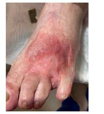 factsheet-2 Wanneer is een wond echt geïnfecteerd?