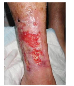 factsheet-4-259x300 Wanneer is een wond echt geïnfecteerd?