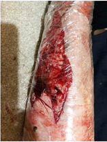 factsheet-5.1 Wanneer is een wond echt geïnfecteerd?