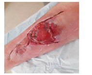 factsheet-5.2 Wanneer is een wond echt geïnfecteerd?