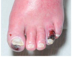 factsheet-6-300x235 Wanneer is een wond echt geïnfecteerd?