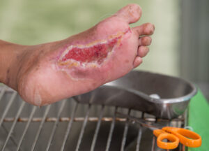 ontstoken-decubitus-voet-300x216 Waarom diabetische wonden soms blijven hangen in ontsteking