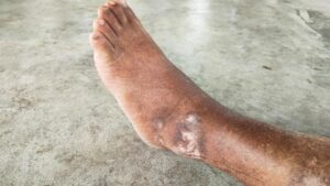 shutterstock_2690795287-300x169 Bloedvatcellen bij diabetes reageren anders dan gedacht